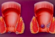 علاج البواسير بالاعشاب