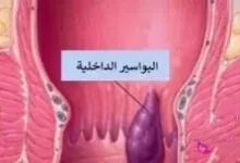 البواسير : تشخيص دقيق وعلاجات متطورة للتحرر من الألم