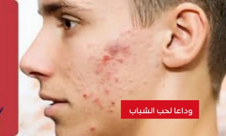 تعرف على كيفية التخلص من حب الشباب للمراهقين