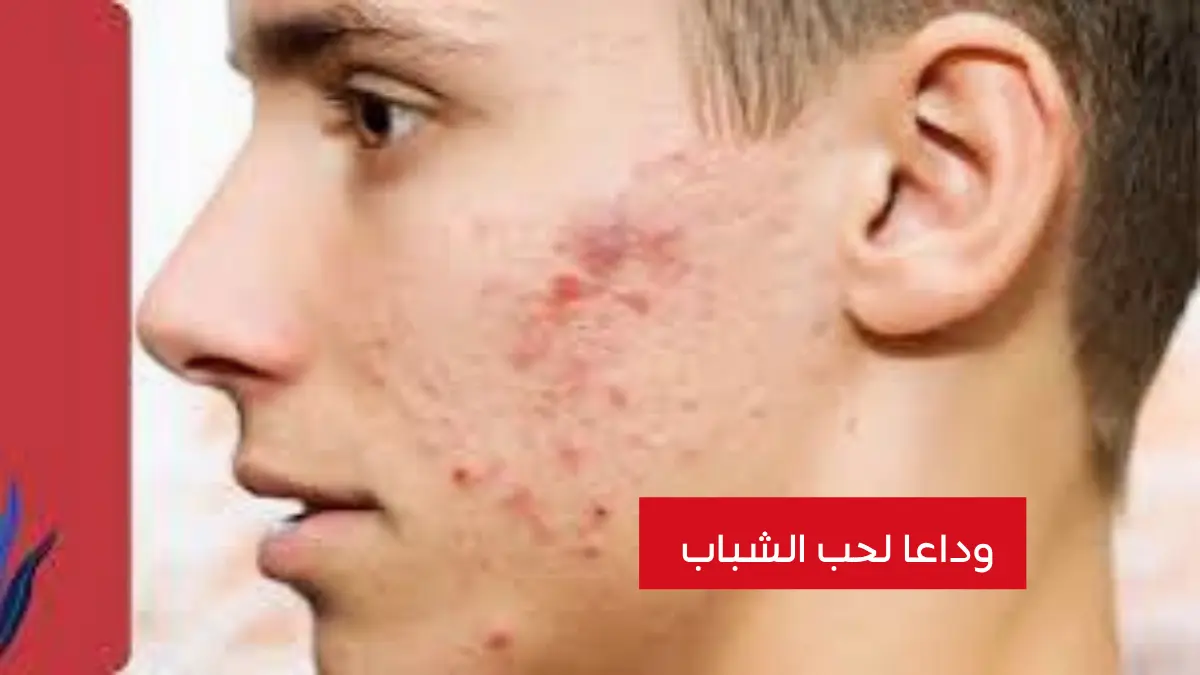 تعرف على كيفية التخلص من حب الشباب للمراهقين